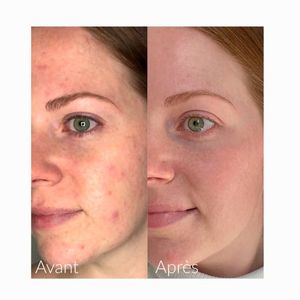 Acne/kvise